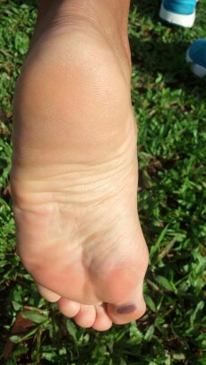 Bolhas causadas com o contato do pé com o tatame.